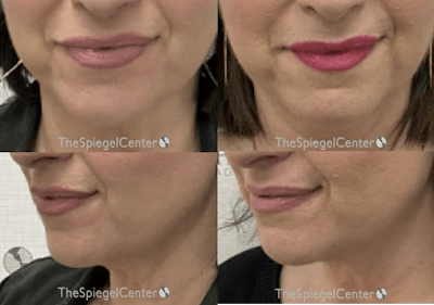 Chin Filler Before & After Gallery - Patient 340308 - Image 1