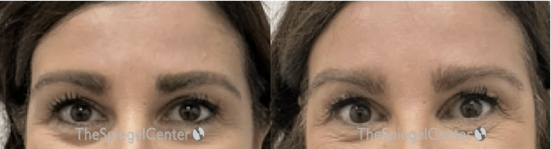 Temple Filler Before & After Gallery - Patient 318897 - Image 1