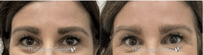 Temple Filler Before & After Gallery - Patient 318897 - Image 1