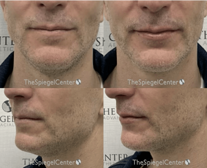 Chin Filler Before & After Gallery - Patient 124235 - Image 1