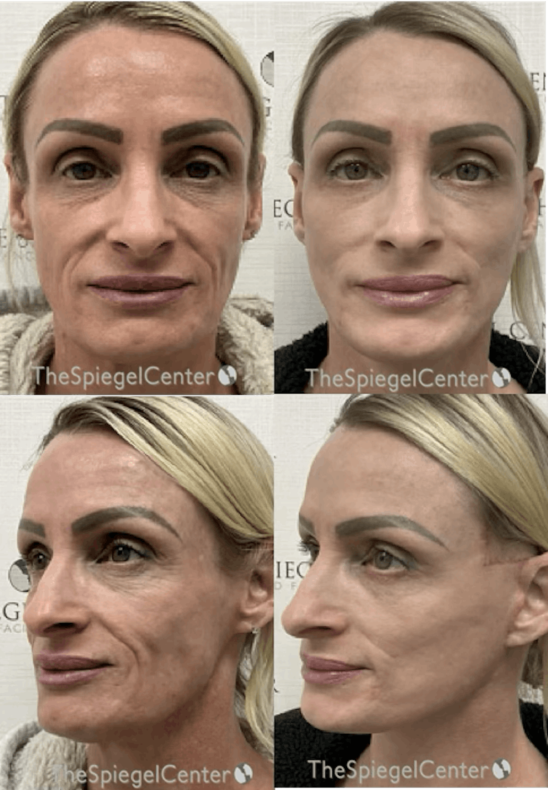 Facelift Before & After Gallery - Patient 356946 - Image 1