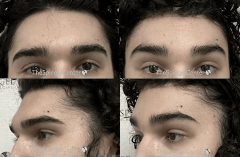Forehead Contouring Before & After Gallery - Patient 294079 - Image 1