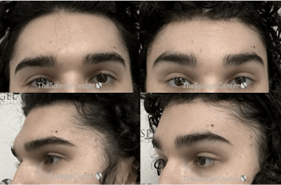 Forehead Contouring Before & After Gallery - Patient 294079 - Image 1