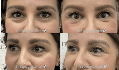 Tear Trough / Under Eye Fillers Before & After Gallery - Patient 390809 - Image 1