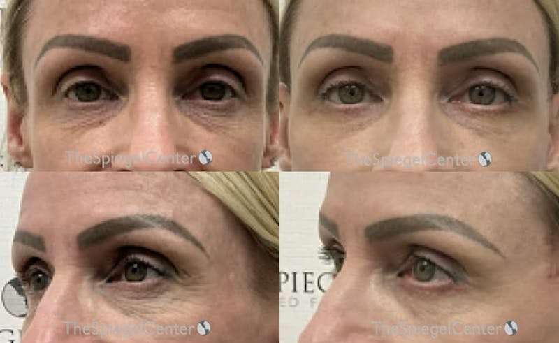 Blepharoplasty Before & After Gallery - Patient 364963 - Image 1