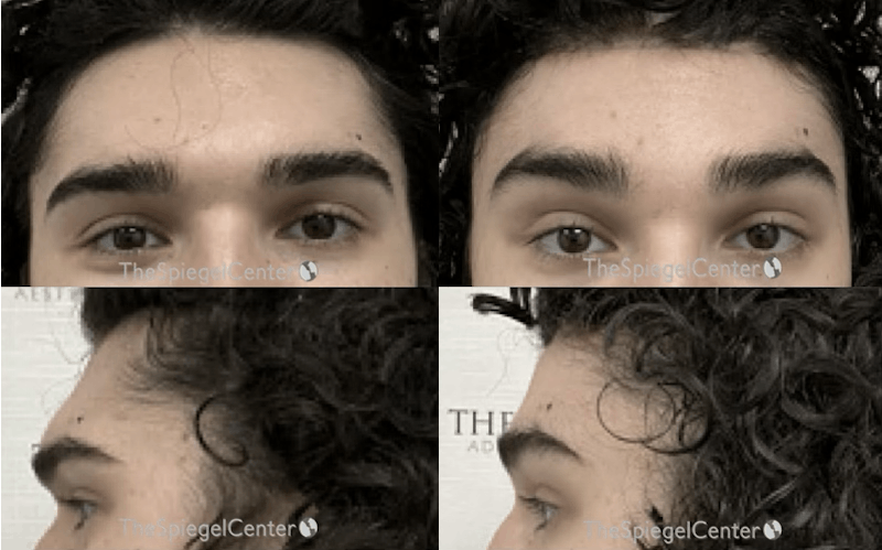 Scalp Advancement Before & After Gallery - Patient 150832 - Image 1
