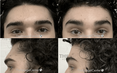 Scalp Advancement Before & After Gallery - Patient 150832 - Image 1