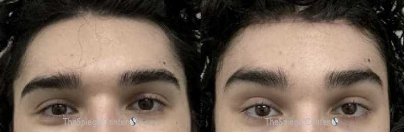 Browlift / Fox Eye Lift Before & After Gallery - Patient 437655 - Image 1