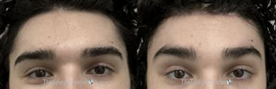 Browlift / Fox Eye Lift Before & After Gallery - Patient 437655 - Image 1