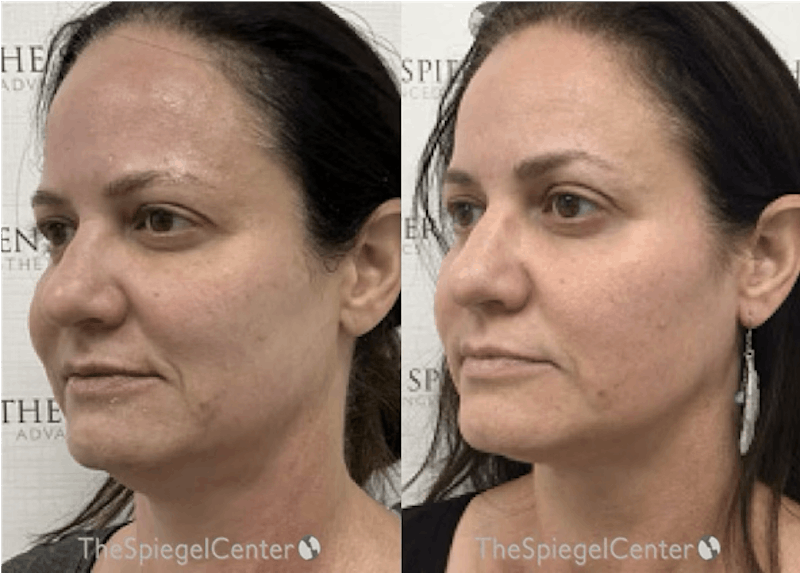 IPL / Intense Pulse Light Before & After Gallery - Patient 150813 - Image 1