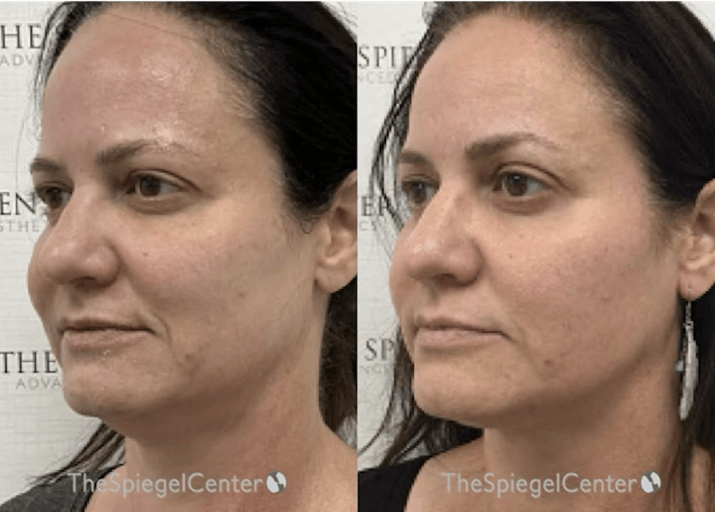 Morpheus8 Before & After Gallery - Patient 227965 - Image 1
