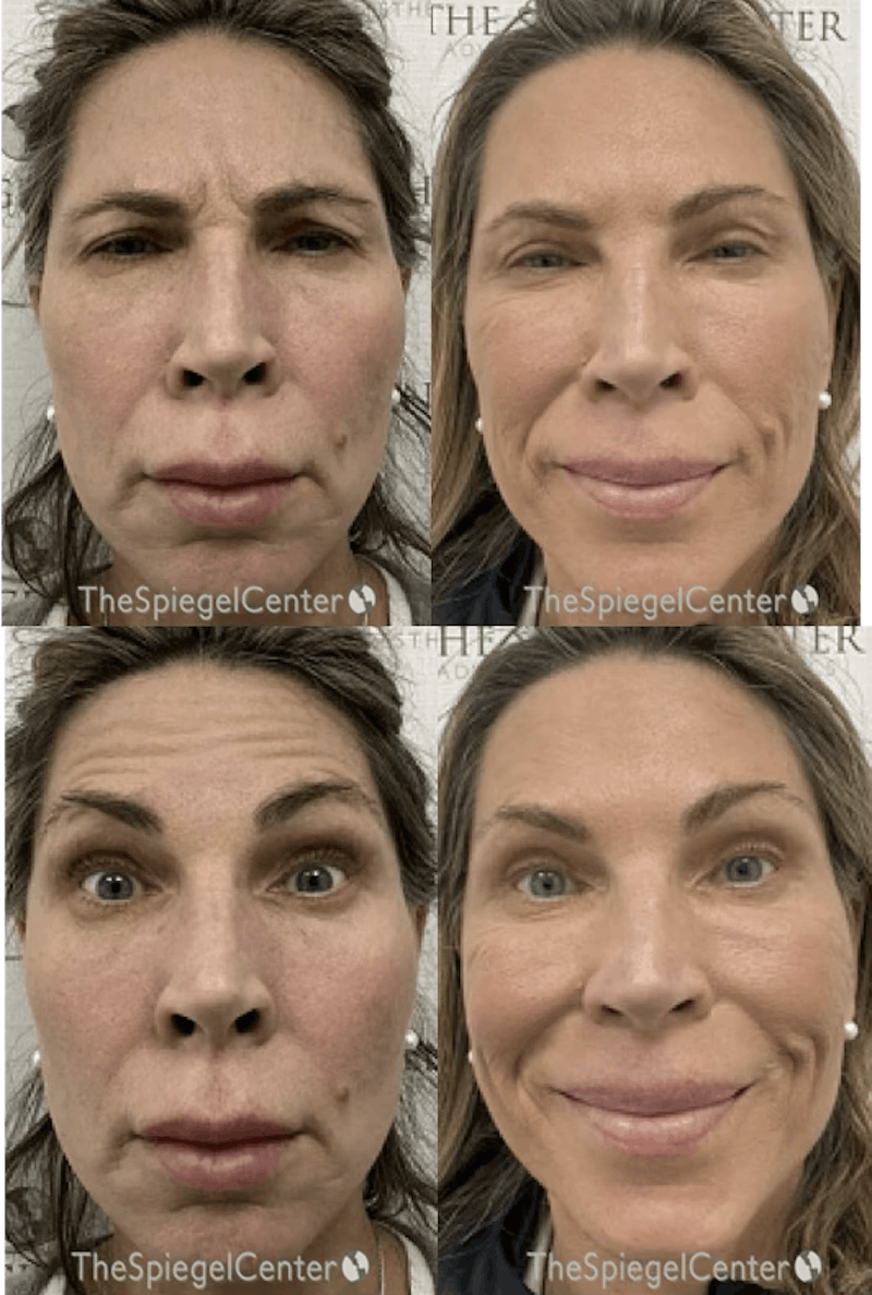 Botox / Dysport / Jeuveau / Xeomin Before & After Gallery - Patient 200957 - Image 1