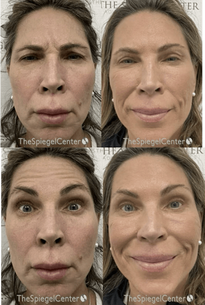 Botox / Dysport / Jeuveau / Xeomin Before & After Gallery - Patient 200957 - Image 1