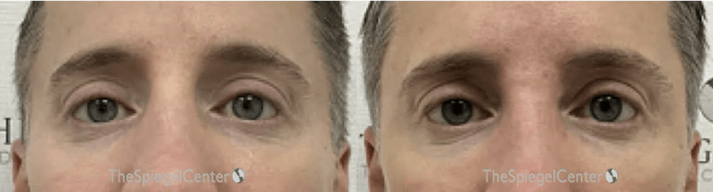 Temple Filler Before & After Gallery - Patient 380815 - Image 1