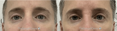 Temple Filler Before & After Gallery - Patient 380815 - Image 1