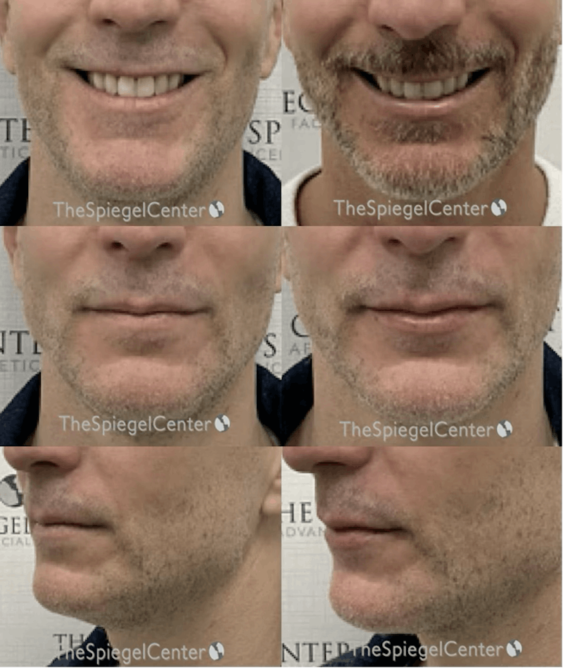 Lip Filler Before & After Gallery - Patient 342625 - Image 1