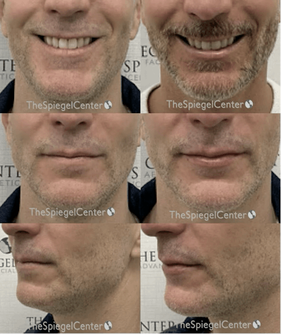 Lip Filler Before & After Gallery - Patient 342625 - Image 1