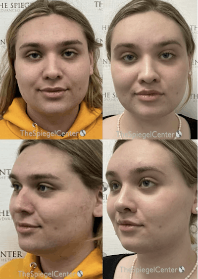 FFS Before & After Gallery - Patient 249477 - Image 1