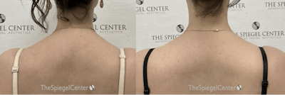 Trapezius Botox (TrapTox) Before & After Gallery - Patient 286444 - Image 1