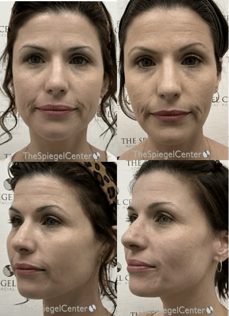 Masseter Botox Before & After Gallery - Patient 223578 - Image 1