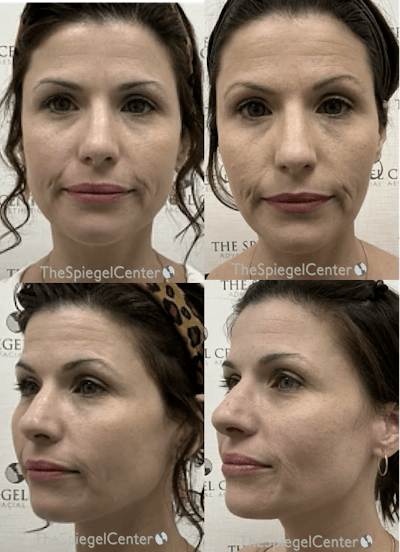 Masseter Botox Before & After Gallery - Patient 223578 - Image 1