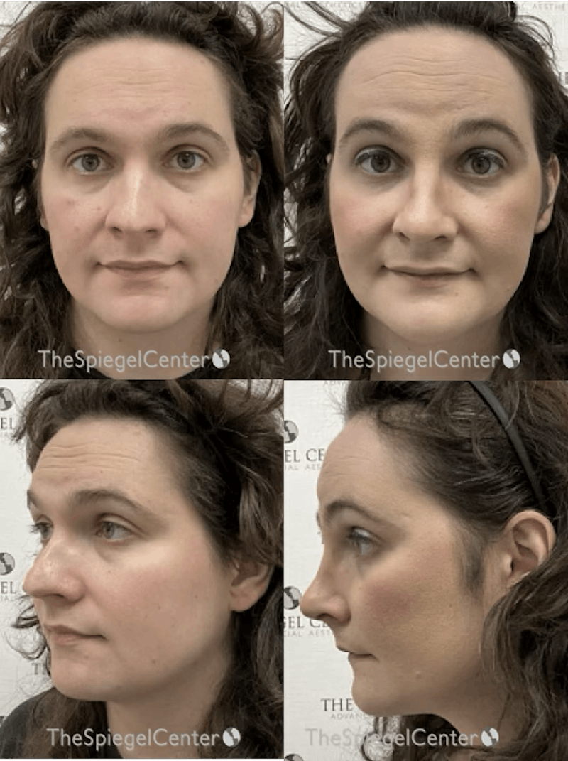 FFS Before & After Gallery - Patient 836839 - Image 1