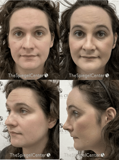 FFS Before & After Gallery - Patient 836839 - Image 1