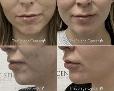 Chin Filler Before & After Gallery - Patient 927782 - Image 1