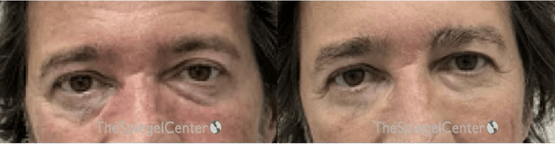 Temple Filler Before & After Gallery - Patient 127044 - Image 1