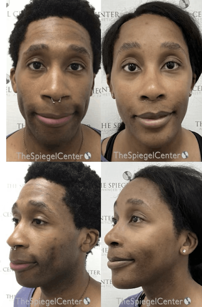 FFS Before & After Gallery - Patient 258882 - Image 1