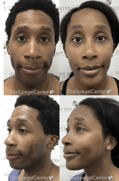FFS Before & After Gallery - Patient 258882 - Image 1