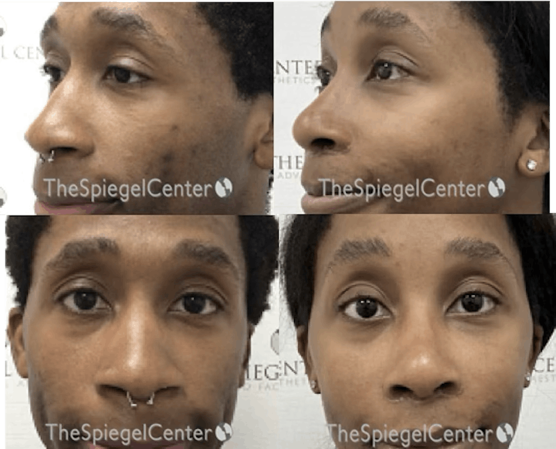 Rhinoplasty Before & After Gallery - Patient 345592 - Image 1