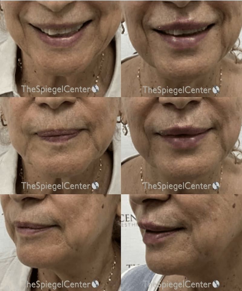 Lip Filler Before & After Gallery - Patient 371353 - Image 1