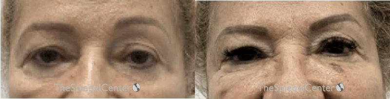 Temple Filler Before & After Gallery - Patient 870220 - Image 1