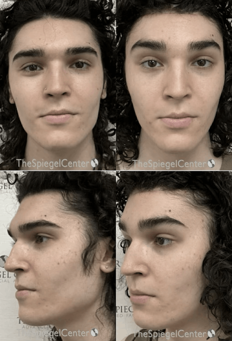 FFS Before & After Gallery - Patient 216863 - Image 1