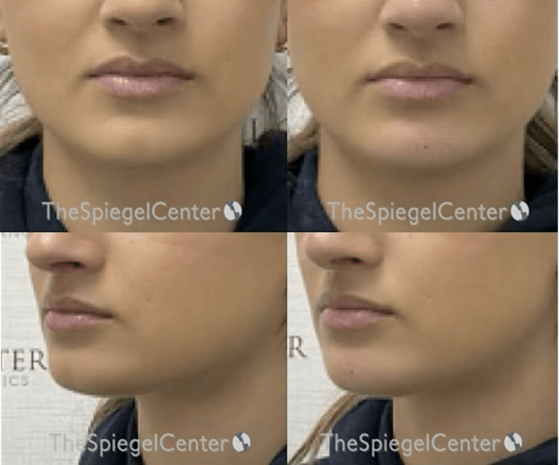 Chin Filler Before & After Gallery - Patient 150137 - Image 1