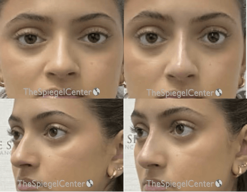 Non-Surgical Rhinoplasty / Nose Filler Before & After Gallery - Patient 191482 - Image 1