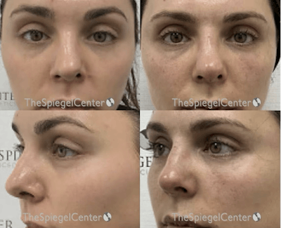 Non-Surgical Rhinoplasty / Nose Filler Before & After Gallery - Patient 391224 - Image 1