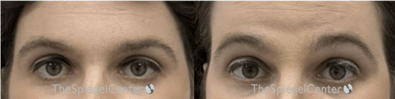 Browlift / Fox Eye Lift Before & After Gallery - Patient 318476 - Image 1