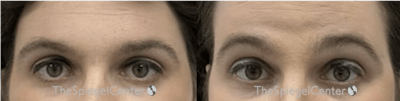 Browlift / Fox Eye Lift Before & After Gallery - Patient 318476 - Image 1