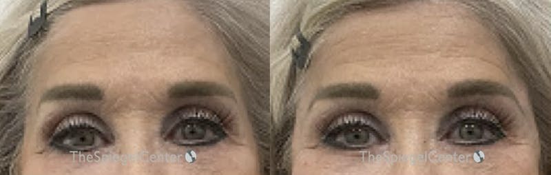 Temple Filler Before & After Gallery - Patient 503124 - Image 1
