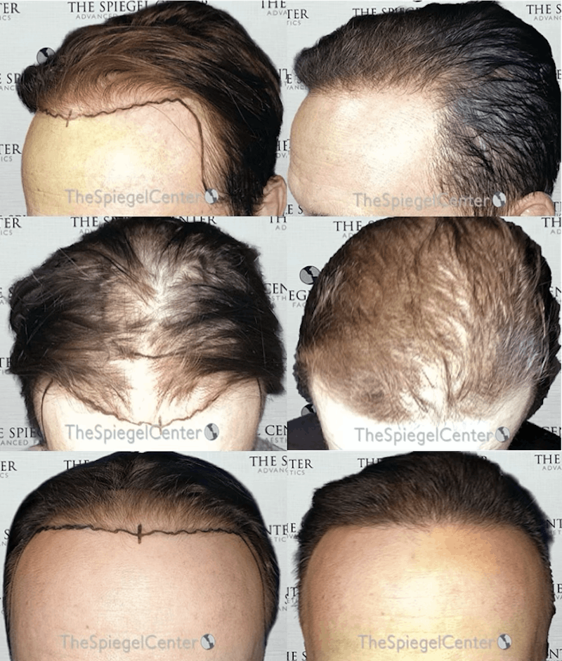 Hair Restoration Before & After Gallery - Patient 301039 - Image 1