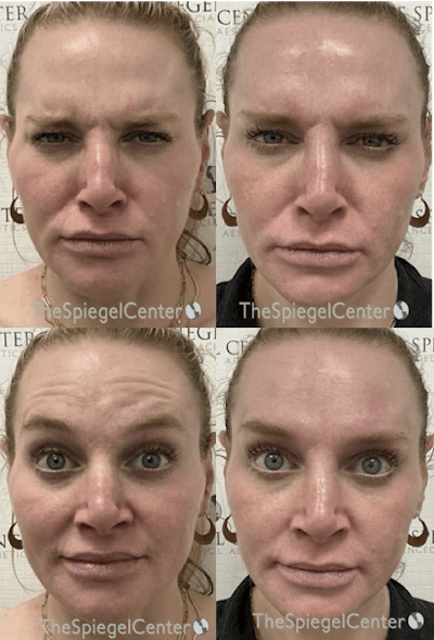 Botox / Dysport / Jeuveau / Xeomin Before & After Gallery - Patient 100711 - Image 1