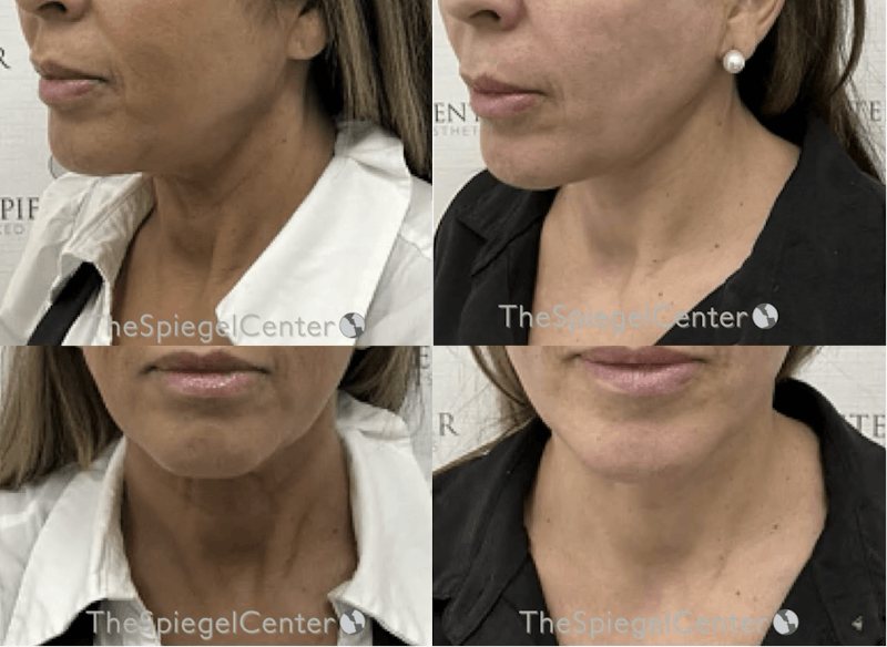 Neck Lift Before & After Gallery - Patient 112706 - Image 1
