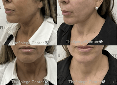 Neck Lift Before & After Gallery - Patient 112706 - Image 1