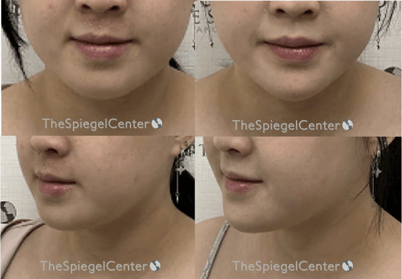 Chin Filler Before & After Gallery - Patient 816144 - Image 1