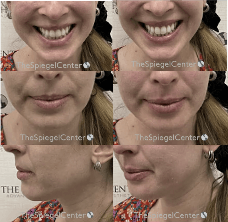 Lip Filler Before & After Gallery - Patient 503312 - Image 1