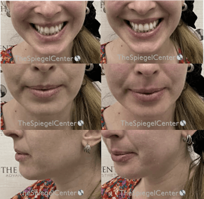 Lip Filler Before & After Gallery - Patient 503312 - Image 1
