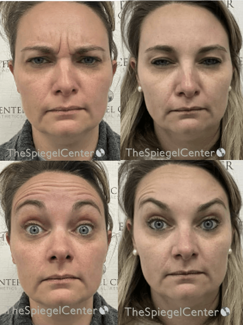 Botox / Dysport / Jeuveau / Xeomin Before & After Gallery - Patient 272161 - Image 1