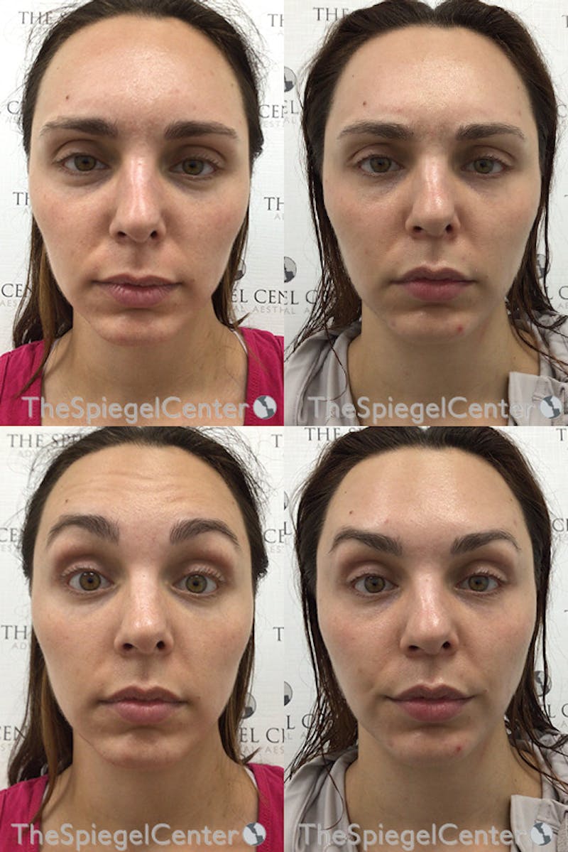 Botox / Dysport / Jeuveau / Xeomin Before & After Gallery - Patient 289828 - Image 1